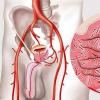 Эмболизация артерий как современный метод лечения аденомы простаты и варикоцеле