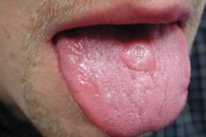 Сифилис на языке: симптомы и лечение Проявления сифилиса во рту