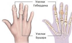 Болят суставы пальцев рук - что делать?