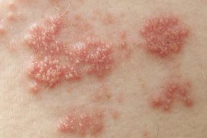 Herpes simplex — особенности заболевания Герпес симплекс 1 и 2 типа