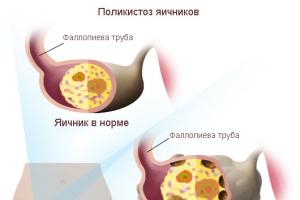 Поликистоз яичников: симптомы