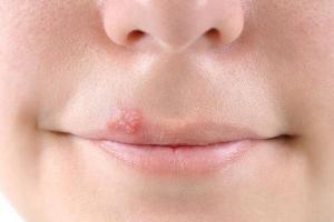 В уголках губ болячки: причины и способы лечения